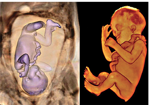 3-D MRI showing a 27-week fetus with brachycephaly, low ear implantation, syndromic profile and vestigial tail 3-D MRI showing a 27-week fetus with brachycephaly, low ear implantation, syndromic profile and vestigial tail