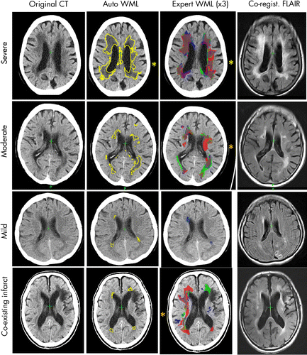 Examples of white matter lesion Examples of white matter lesion
