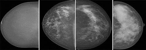 Mammograms show volumetric breast density classified as Volpara density grade 1, 2, 3, and 4 with automated volumetric breast density measurement Mammograms show volumetric breast density classified as Volpara density grade 1, 2, 3, and 4 with automated volumetric breast density measurement