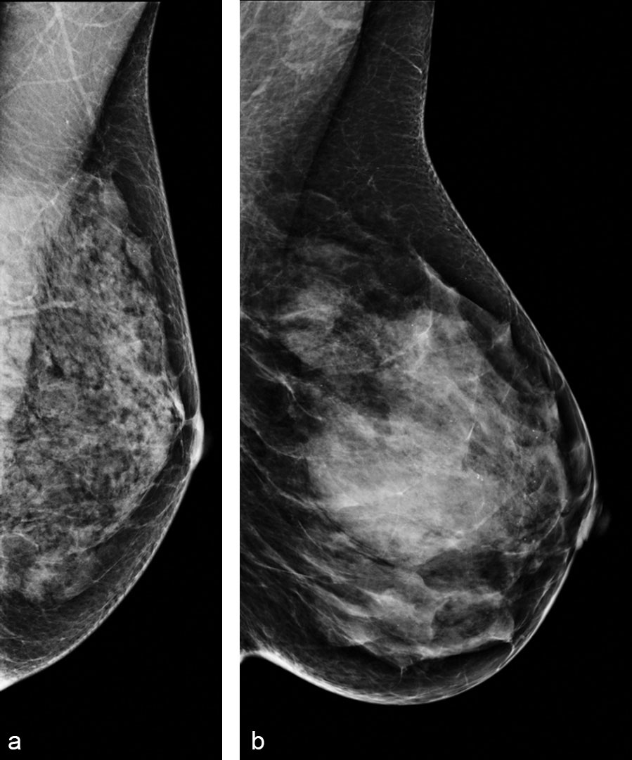 breast