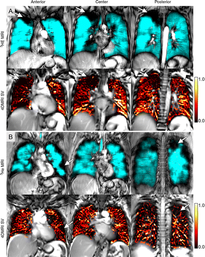 Helium 3 (3He) and four-dimensional (4D) MR images (4DMRI) in representative subject with asthma Helium 3 (3He) and four-dimensional (4D) MR images (4DMRI) in representative subject with asthma