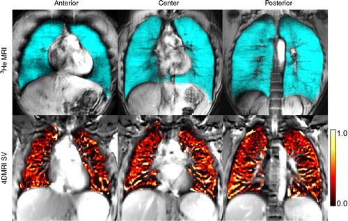 Helium 3 (3He) and four-dimensional (4D) MR images Helium 3 (3He) and four-dimensional (4D) MR images