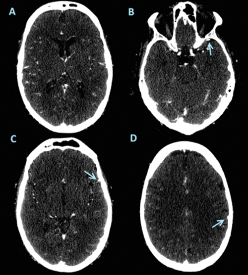 Images from baseline CT angiography in 61-yearold man  Images from baseline CT angiography in 61-yearold man