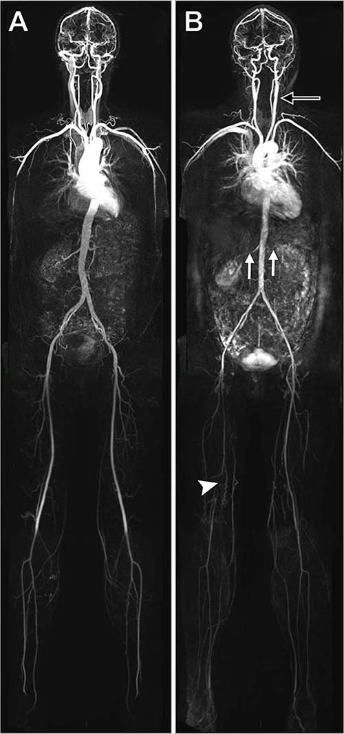 Whole-body angiograms Whole-body angiograms