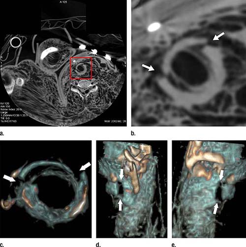 Axial cervical postmortem CT scan Axial cervical postmortem CT scan