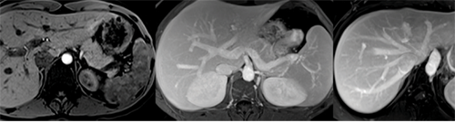 Biliary anatomy displayed with MR cholangiographic (MRCP) Biliary anatomy displayed with MR cholangiographic (MRCP)