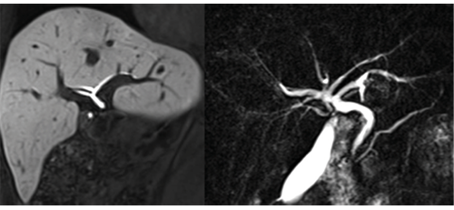 Hepatic arterial (left), portal venous (middle) and hepatic venous (right) anatomy displayed Hepatic arterial (left), portal venous (middle) and hepatic venous (right) anatomy displayed