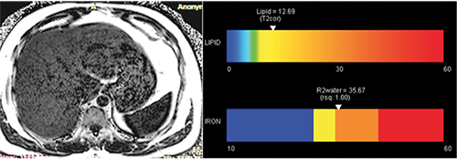 Liver fat quantification by MRI in a potential liver donor Liver fat quantification by MRI in a potential liver donor