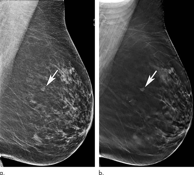 2D mammography