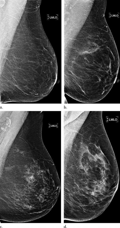 Breast-Radiology-2