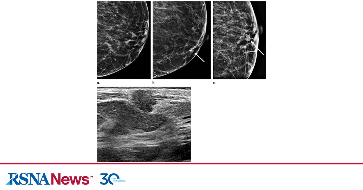dbt-for-invasive-cancer-detection | RSNA