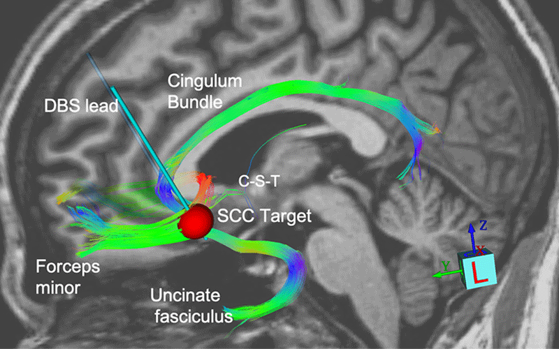 Deep Brain feature