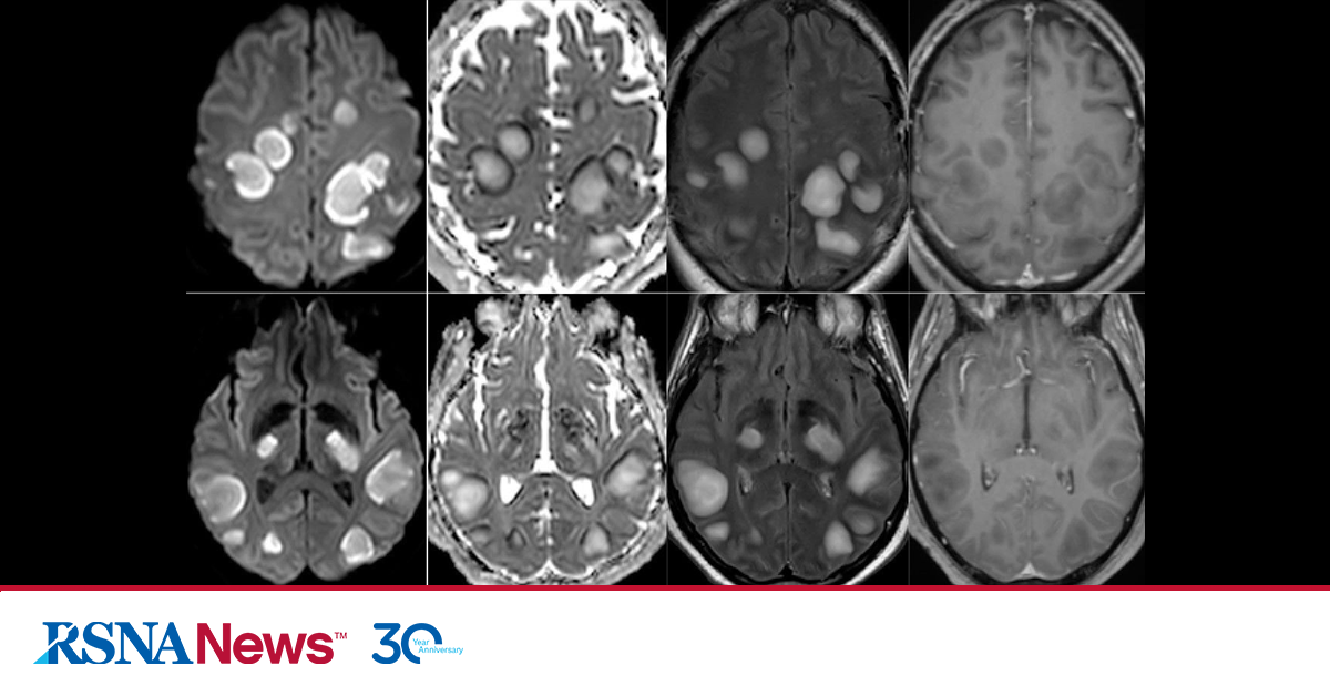BrainMRIFindingsInCOVID19 RSNA(00)