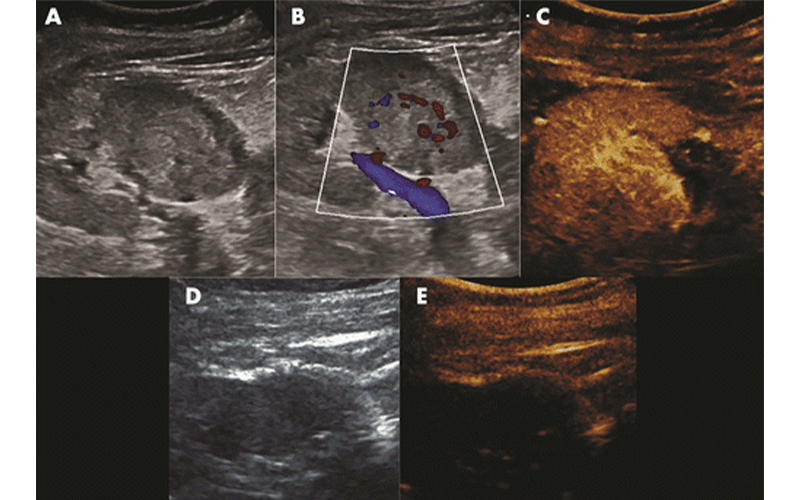 Ablation RCC