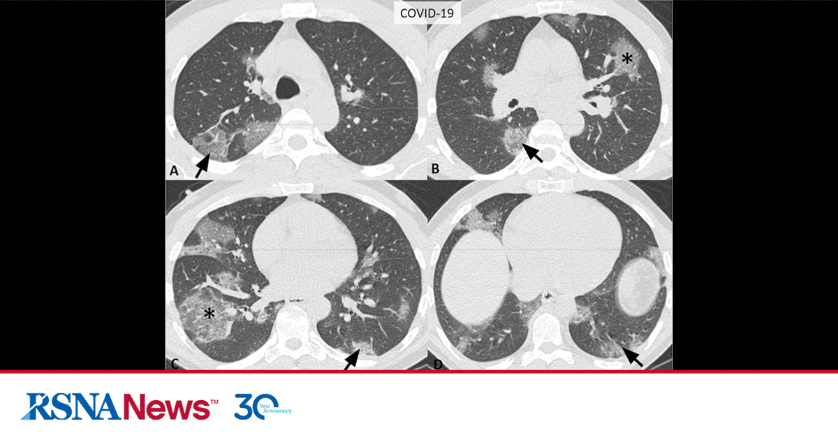 Consensus Covid 19 Reporting Rsna