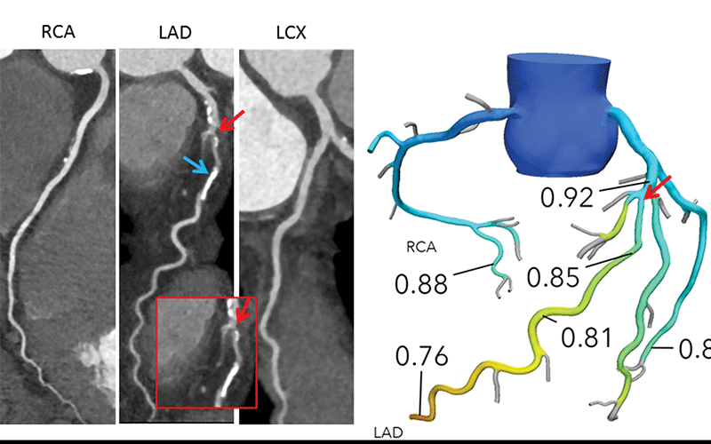 CTA Fractional Flow Research Image