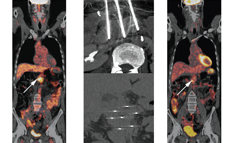 RCC Ablation Triple Image