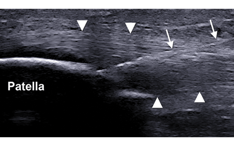 PRP knee jumpers feature