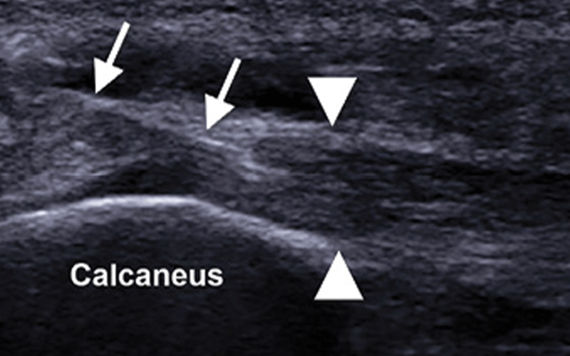 PRP plantar fascititis feature