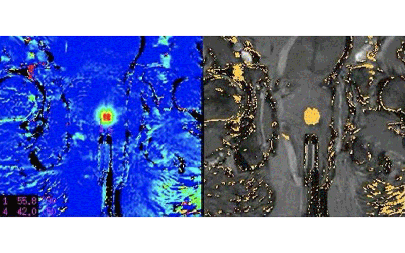 prostate thermometry feature
