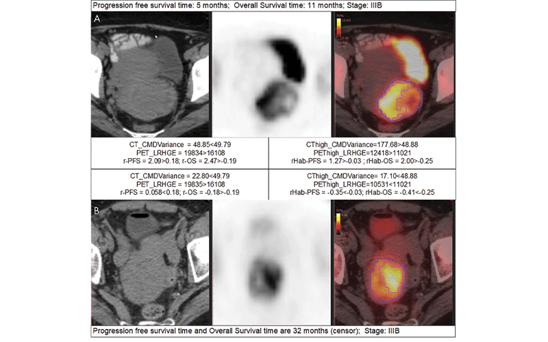 cervical cancer research feature