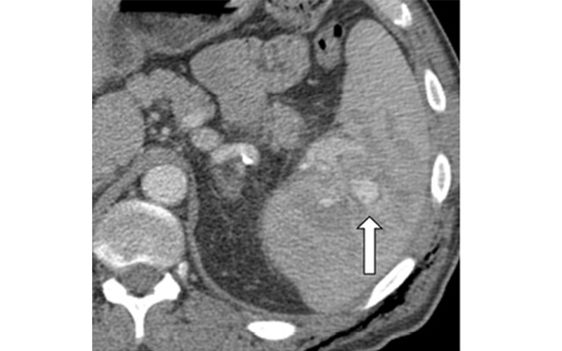 splenic injuries feature