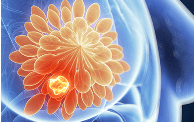 Breast Imaging AI
