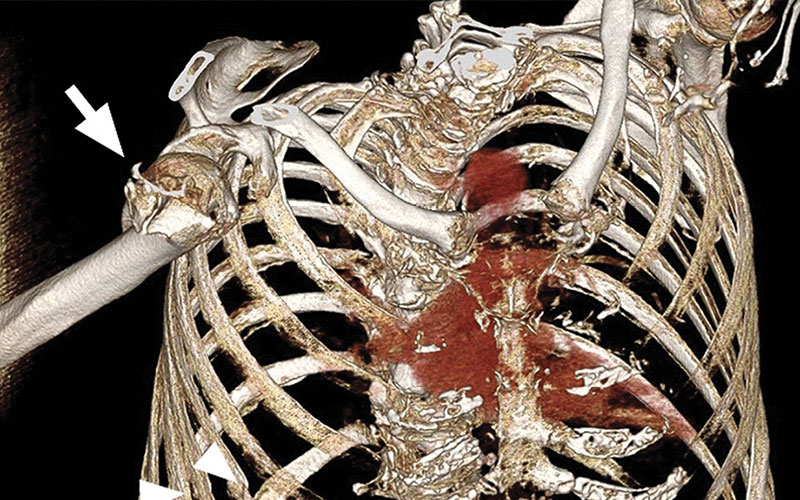 Elderly injury feature