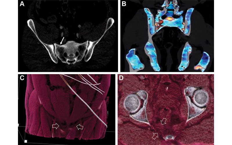 pelvic fracture feature