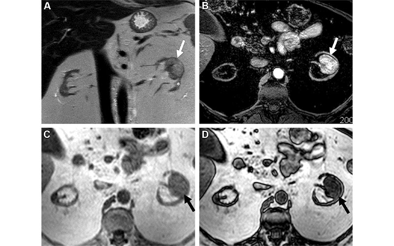 Renal masses
