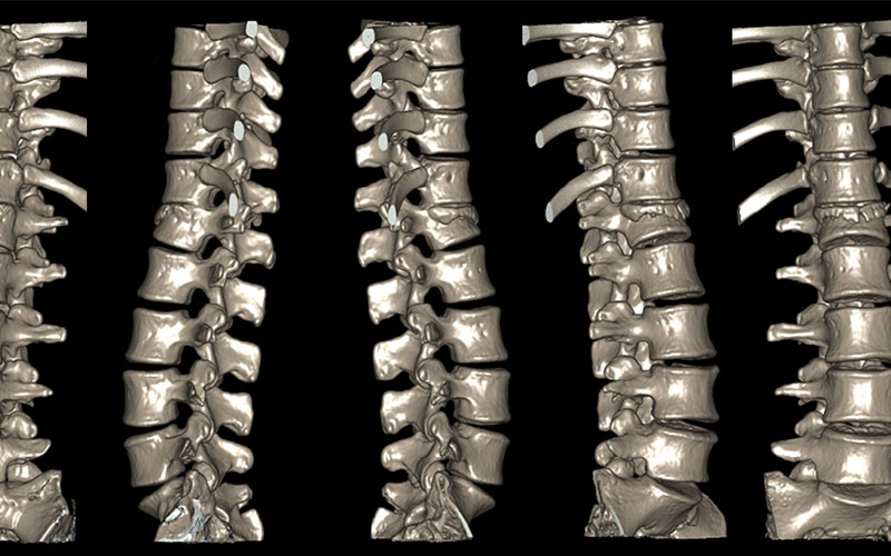 Spine generic