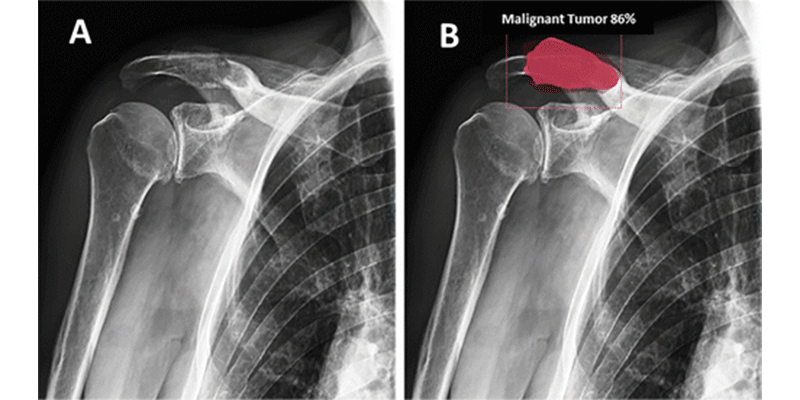 Fig 7 Bone tumors