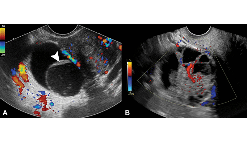 Gupta ovarian cancer