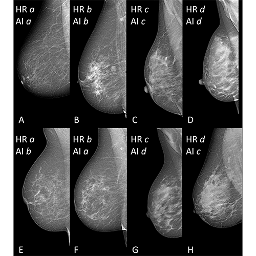 Dense Breast AI