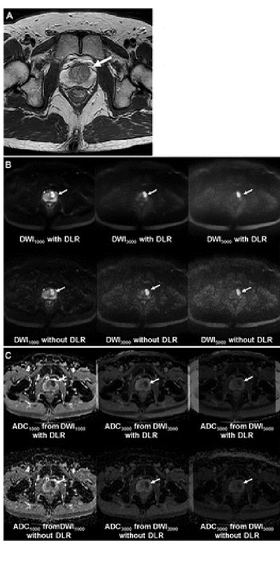 Ohno prostate cancer image