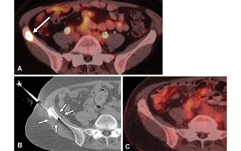 Palliative IR image 1