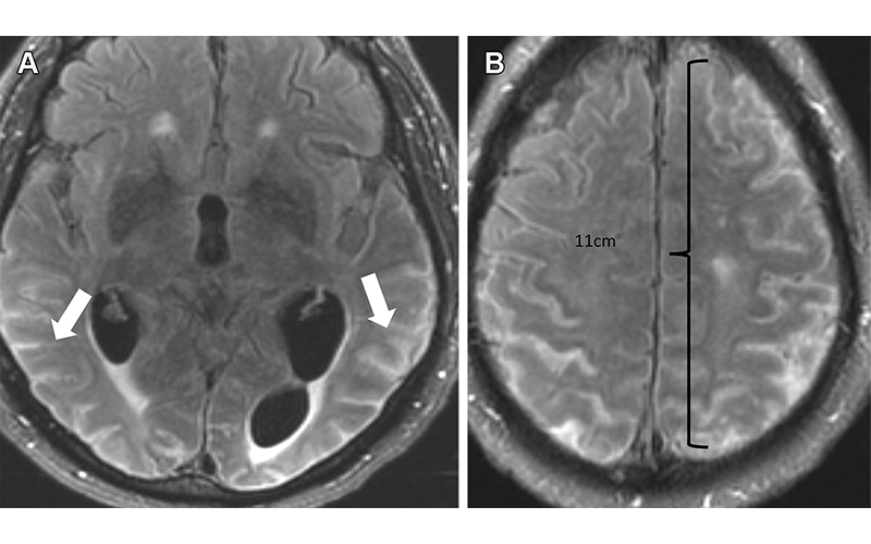 Agarwal RG fig 10 Alzheimer's Disease treatment side effects