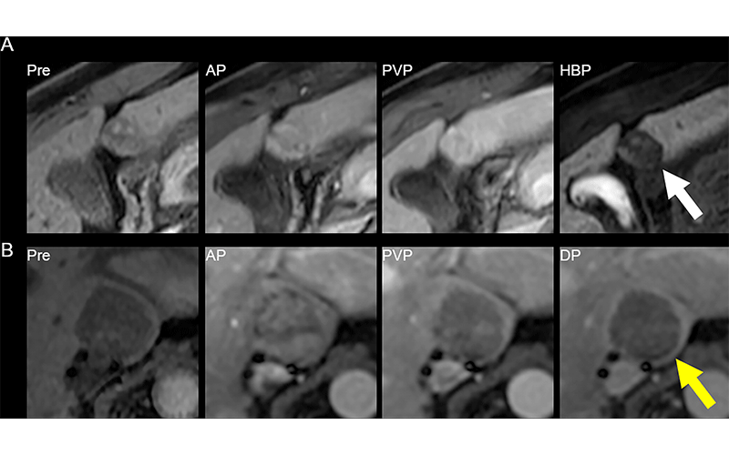 LI-RADS Radiology image