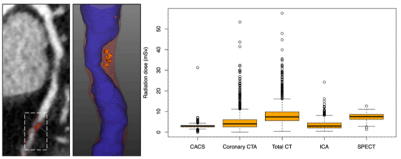 research image for Michelle Williams' study about radiation exposure in the SCOT-HEART trial