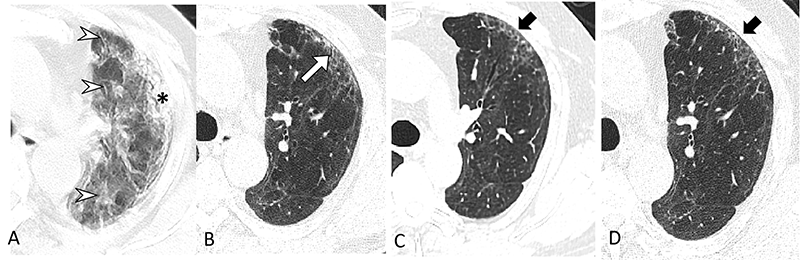 Shi Radiology CT Lungs COVID