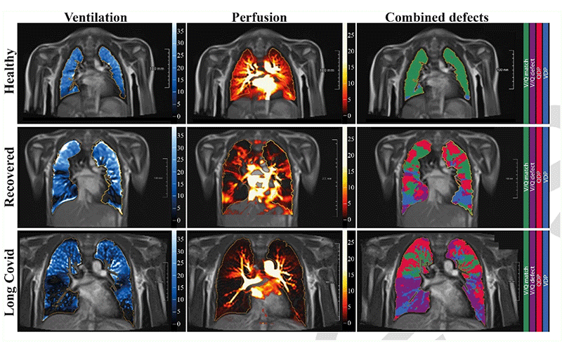 Pediatric long COVID radiology