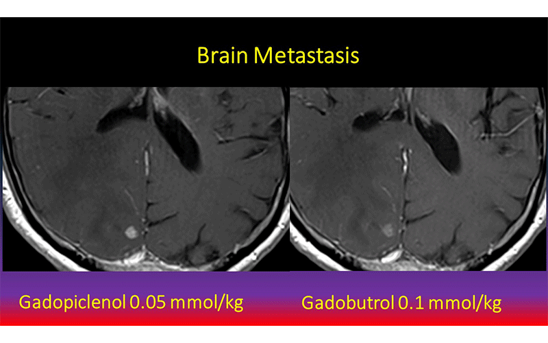 “Contrast enhanced MRI with Gadopiclenol (left) better demonstrating a brain metastasis than comparator agent (right).” Images courtesy of J. Hao.