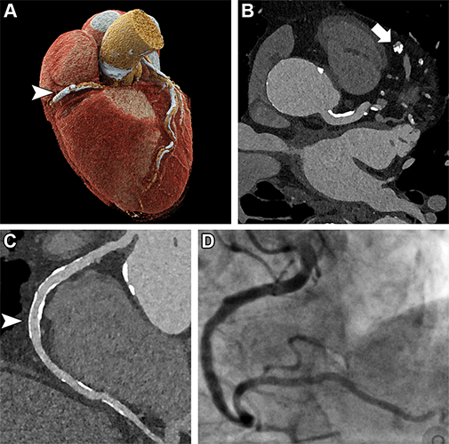 Hagar Radiology ultrahigh resolution coronary CT angiography in an 85 year old man