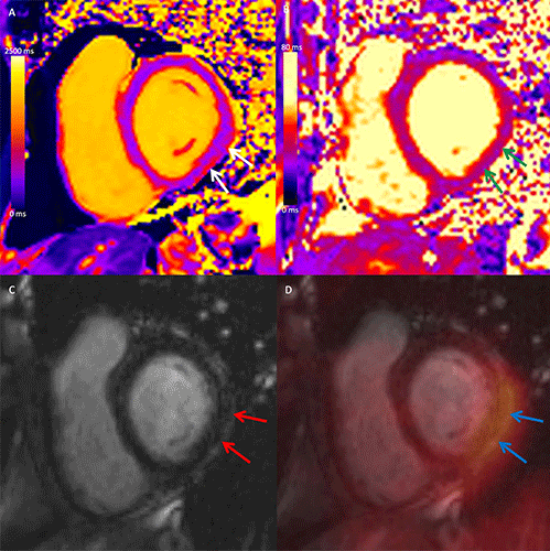 Hanneman RYCTI PET/MRI Myocarditis COVID-19 Vaccination