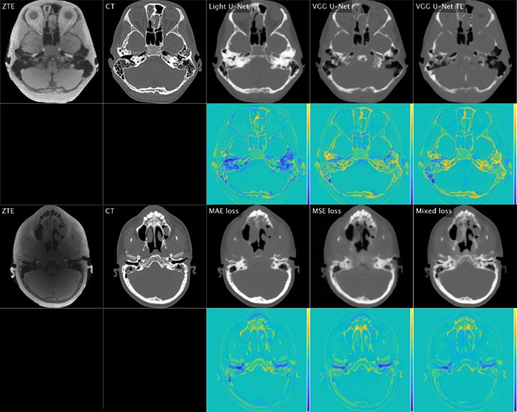 Comparison of ZTE, ground truth CT and deep learning-generated synthetic CT