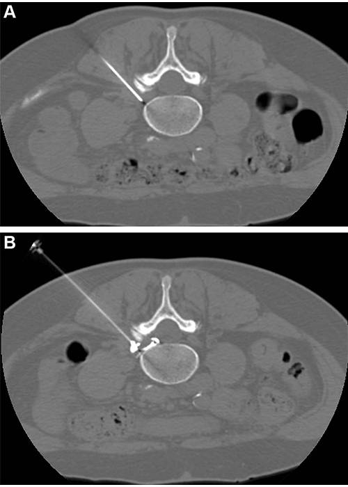 Napoli Radiology Interventional Sciatica TFESI