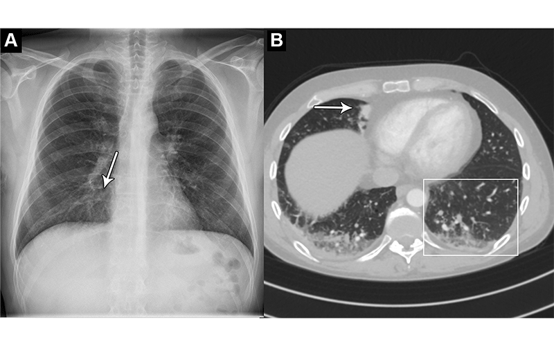 Plesner Radiology x-ray of 44 year old man with chest pain and dypsnea