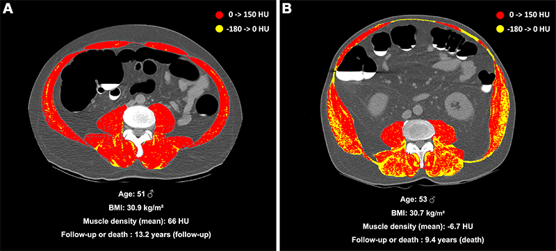 Nachit Radiology Fig 3 Myosteatosis