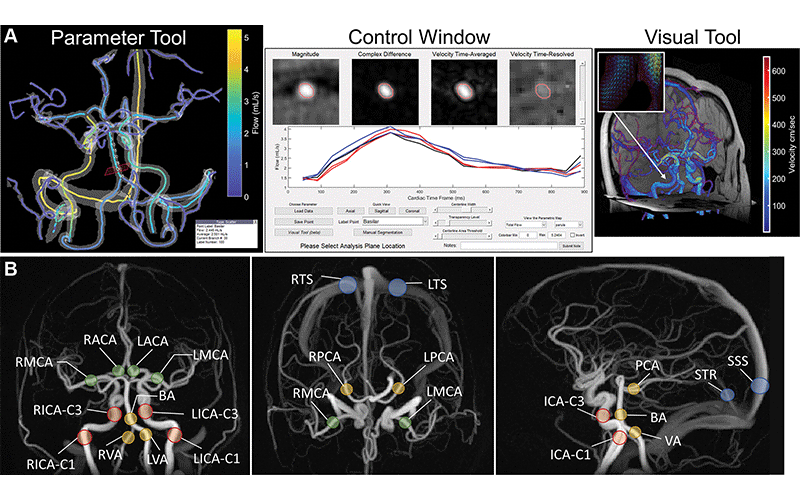 Eisenmenger and Steinman Radiology 4D Flow MR Mapping Cerebral Hemodynamics