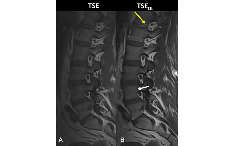 Accelerated Spine MRI